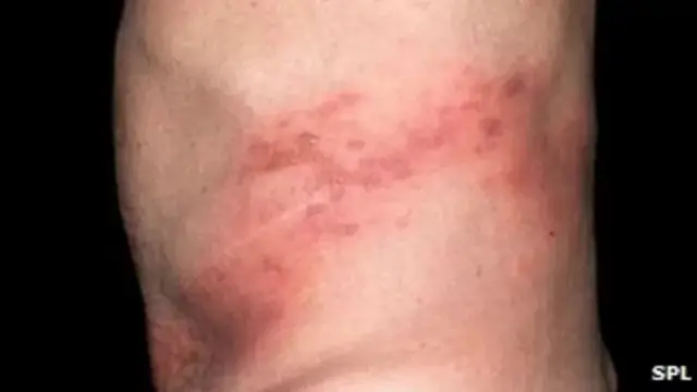 कांजिण्या : काय करावं आणि काय करू नये?