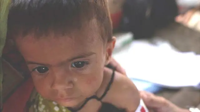 समीना का परिवार उसे पर्याप्त भोजन नहीं दे पा रहा, वो कुपोषित है.