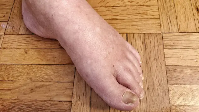 हत्तीरोग