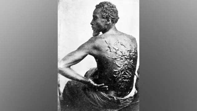 Gordon, também conhecido como "Whipped Peter", um ex-escravizado, mostra suas costas com cicatrizes em um exame médico, Baton Rouge, Louisiana, 2 de abril de 1863.