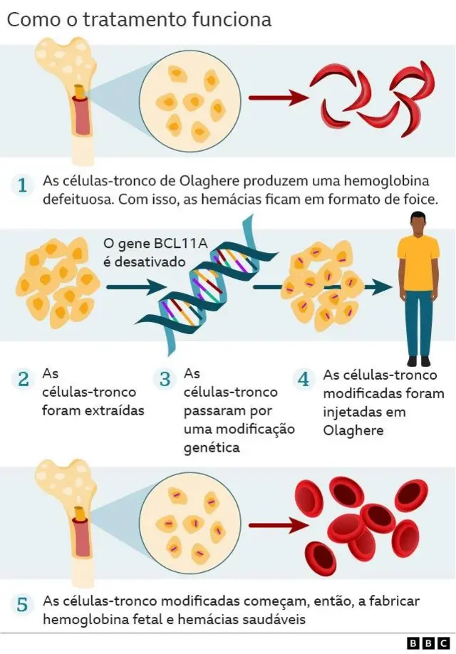 Infográfico sobre novo tratamento para doença falciforme