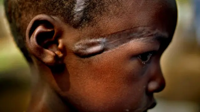 Огнестрельное оружие - вовсе не обязательное условие насилия, как свидетельствует эта фотография ребенка из племени хуту, на лице которого шрам от мачете, полученный в 1994 году, во время руандийского геноцида