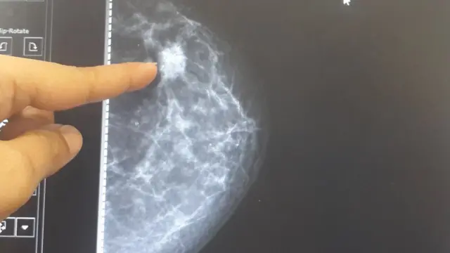 स्तन कैंसर