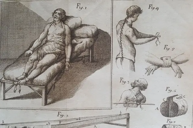 El primer dibujo de una camisa de fuerza, realizado por Vincenzo Chiarugi en 1794.