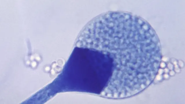 மியூகோர்மைகோசிஸ்