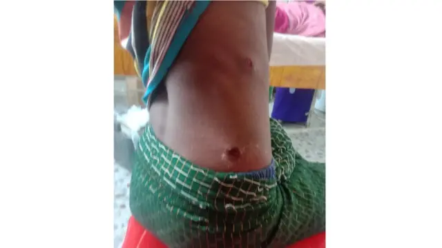 ဒဏ်ရာရကလေးငယ်တစ်ဦး