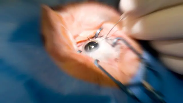 ਲੇਸਿਕ ਸਰਜਰੀ