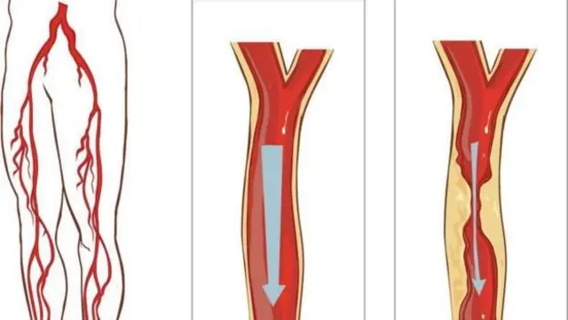 पिंडऱ्या, बीबीसी मराठी, आरोग्य, पिंडरी, calf, calves BBC Marathi Health