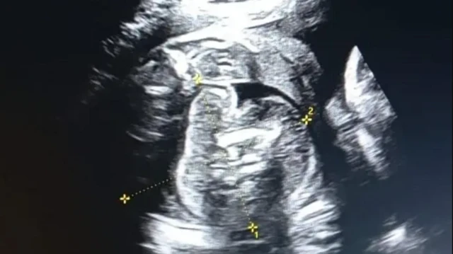 ਸੋਨੋਗ੍ਰਾਫੀ