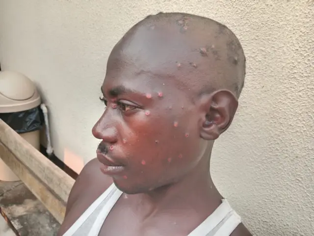 Samuel Irambona mu kigo c'ahavurirwa Mpox mu bitaro Roi Khaled mu Kamenge, ku wa 22 Myandagaro 2024