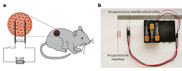ฝังเข็ม