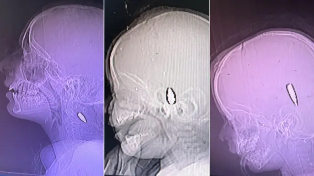 Çocukların başlarını gösteren tıbbi tarama görüntüleri- birincisinin boynunda bir kurşun, ikincisinin başının orta kısmında ve üçüncüsünün başında kulağın hemen üstünde bir kurşun görülebiliyor.