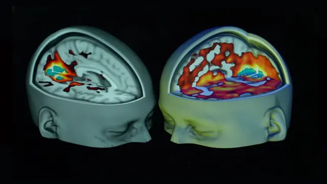 Imagens do cérebro hiperativo de um usuário de psicodélicos, ao lado de alguém que não ingeriu a substância
