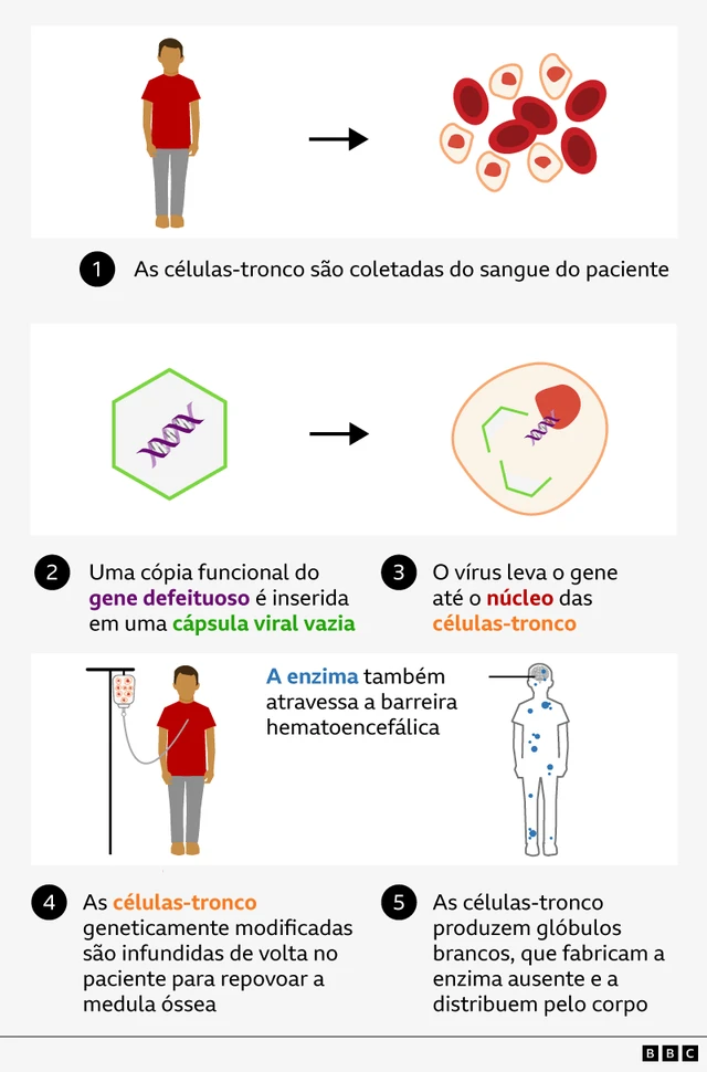 1. As células-tronco são coletadas do sangue do paciente
2. Uma cópia funcional do gene defeituoso é inserida em uma cápsula viral vazia
3. O vírus leva o gene até o núcleo das células-tronco
4. As células-tronco geneticamente modificadas são infundidas de volta no paciente para repovoar a medula óssea
5. As células-tronco produzem glóbulos brancos, que fabricam a enzima ausente e a distribuem pelo corpo
