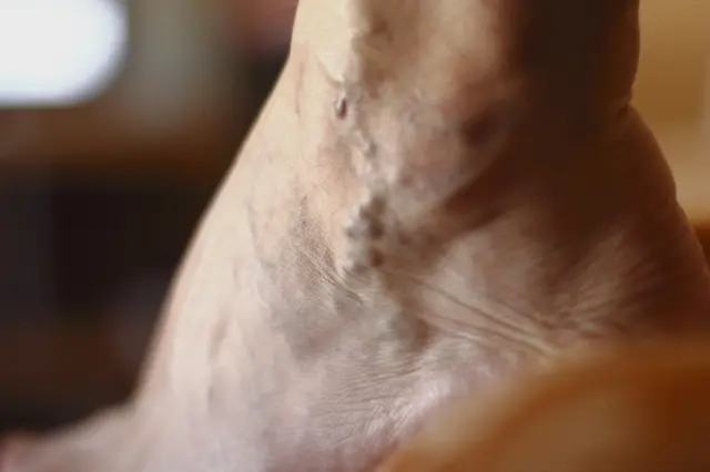 స్పైడర్ వెయిన్స్