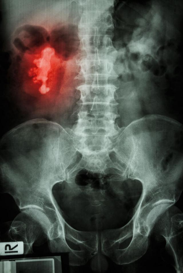 Imagem de raio-x detecta uma pedra chifre de veado no rim direito de paciente