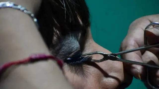 Harka baallee ijaa miidhagsaa jiru