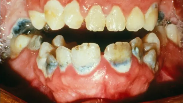 Gingivitis