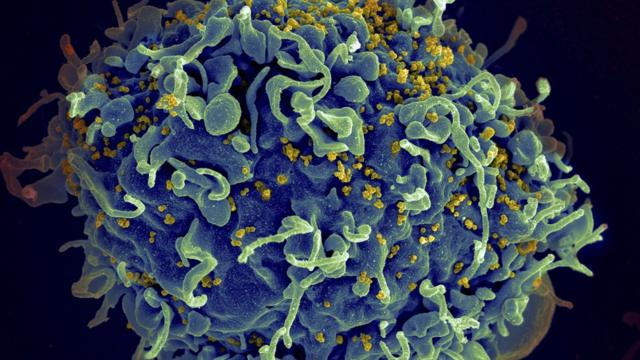 Eletromicrografia mostra HIV infectando célula humana