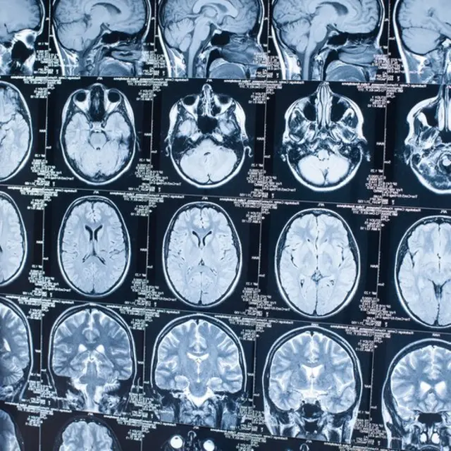 Radiografía del cerebro.