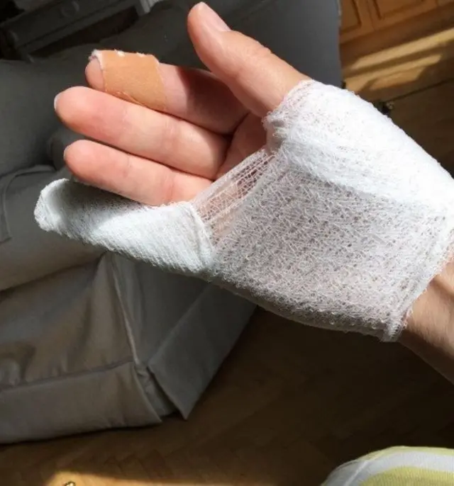 தன் கையில் உள்ள காயத்தை காண்பிக்கிறார் டர்னர்