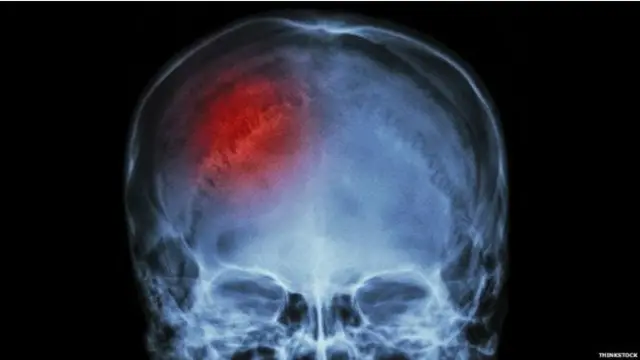 ආතතිය හේතුවෙන් ප්‍රදාහය