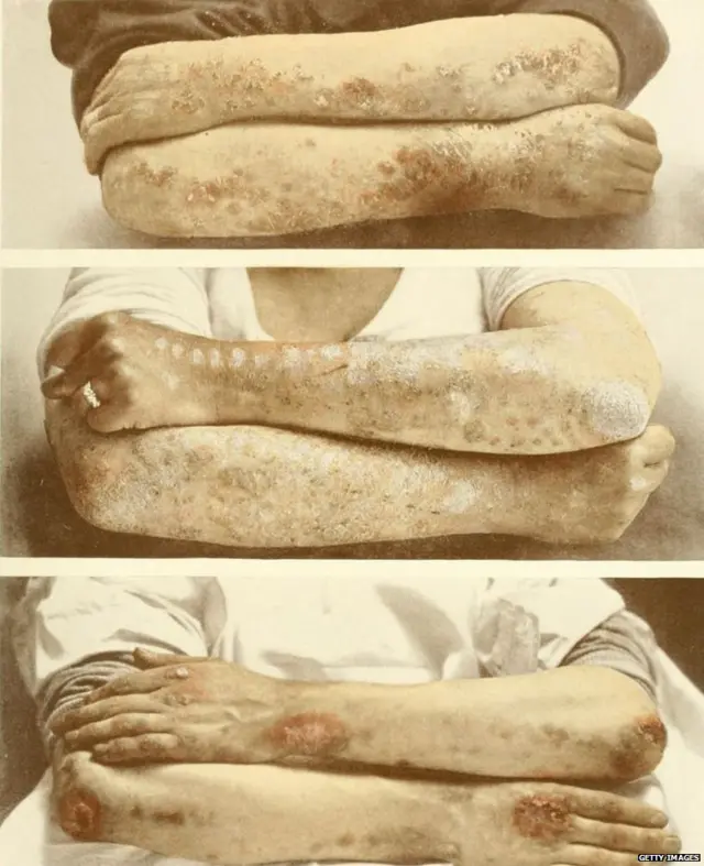 सोरायसिस