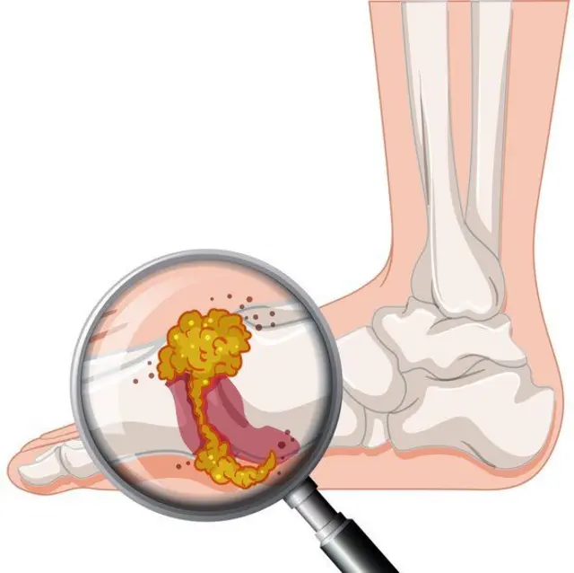 కీళ్ల నొప్పులు