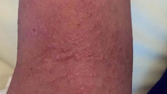 Brazo de Jay Virdee, afectado por su esclerodermia