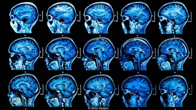 Radiografias do cérebro