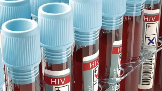 एचआईवी पॉज़िटिव
