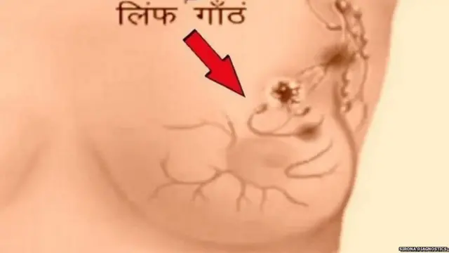 ਜਾਣਕਾਰਾਂ ਦਾ ਮੰਨਨਾ ਹੈ ਕਿ ਅਗਲੇ ਦਸ ਸਾਲਾਂ ਵਿੱਚ ਬ੍ਰੈਸਟ ਕੈਂਸਰ ਬਾਕੀ ਸਭ ਕੈਂਸਰਾਂ ਨੂੰ ਪਿੱਛੇ ਛੱਡ ਸਕਦਾ ਹੈ