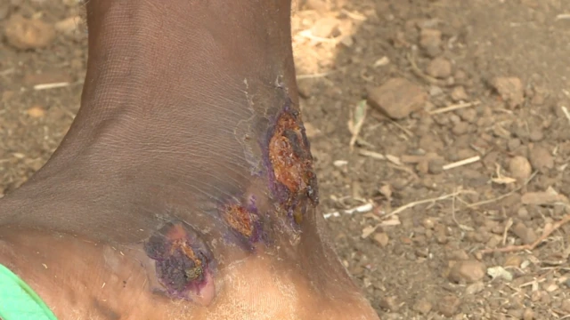 ረኔ ብእግሩ ክጓዓዝ ክብል በሽረጥረጥ ዝበላ ኣእጋሩ