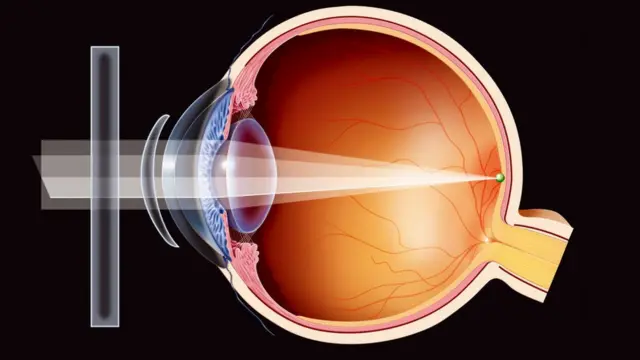 Astigmatism