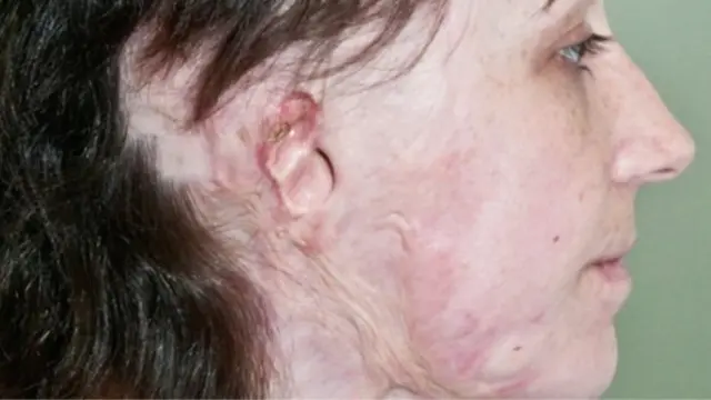 Адель зі шрамами