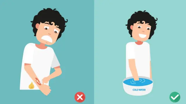 বিশেষজ্ঞরা বলছেন, শুধু পানি ঢাললেই পোড়ার পরিমাণ কমিয়ে আনা যেতে পারে।