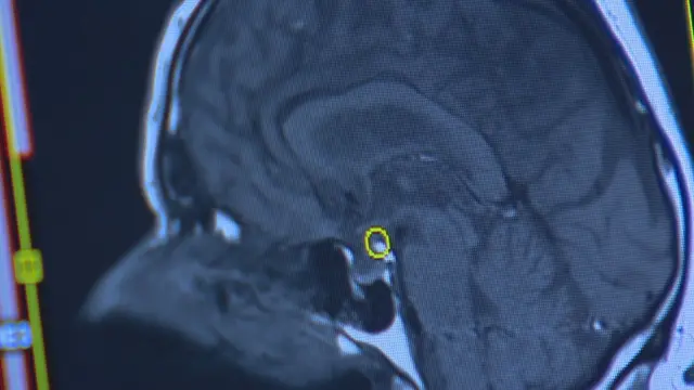 A study led by Scottish researchers has found more than 100 genes linked to depression