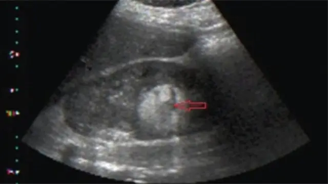 Dokita n lo ẹrọ Ultrasound lati mọ boya obinrin ni oyun iju