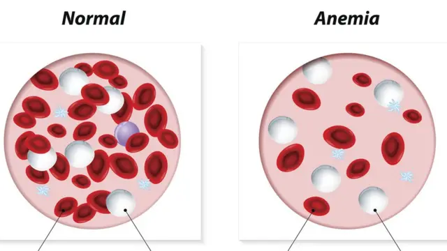 Ilustração mostra a diferença entre amostrasinfo freebet tanpa deposit 2024sangue saudável e anêmico