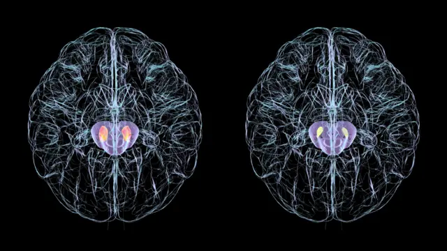 Illustration of two brains, each with two substantia nigrae located within the midbrain region. On the left, the substantia nigrae are larger. On the right, they are smaller.