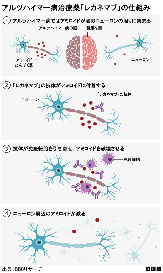 アルツハイマー病治療薬「レカネマブ」の仕組み