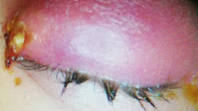 ያበጠ የሴት አይን