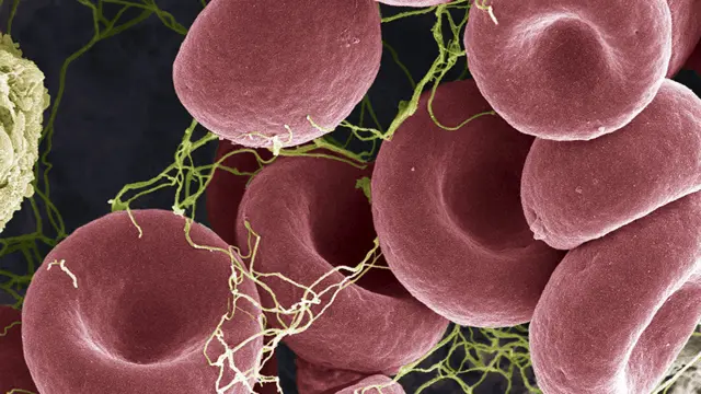 Blood clot, coloured scanning electron micrograph