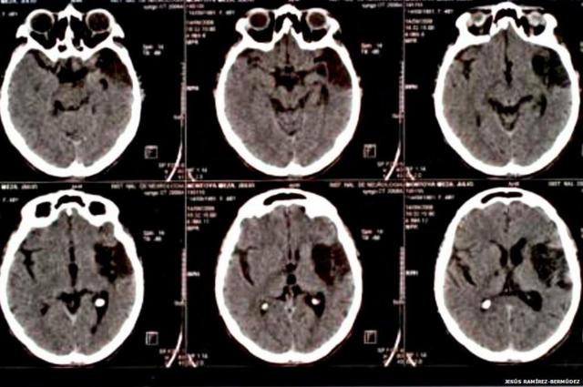 Danos no cérebrobayern rb leipzigum paciente com a síndrome