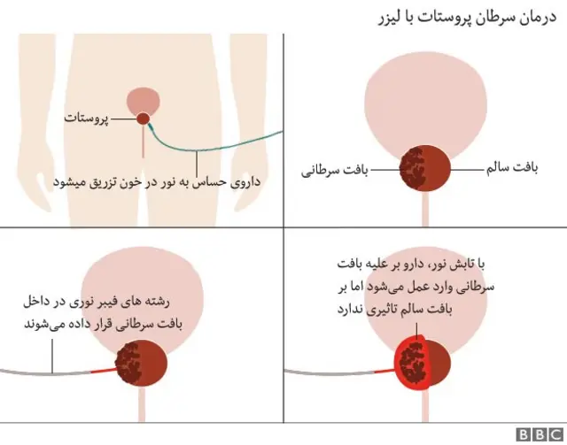 سرطان پروستات