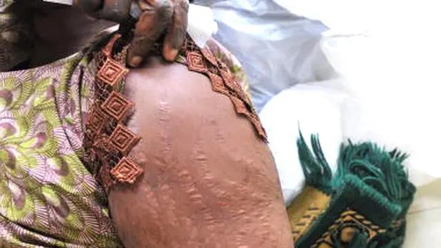 Umugore ku bitaro by'i Dakar mu murwa mukuru wa Senegali, yerekana ingaruka yatewe n'amavuta yo kwitukuza, mu kwezi kwa gatanu mu mwaka wa 2009