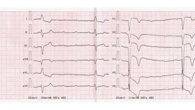 हार्ट अटैक, स्वास्थ्य