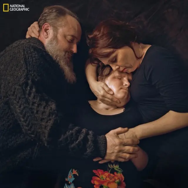 Imagem mostra Katie Stubblefield, já com o novo rosto, sendo abraçada pelos pais. Ela é a mais jovem americana a passar por um transplante facial. Foi submetida à cirurgia após uma tentativagrupo telegram arbetysuicídio que a fez perder grande parte do rosto.