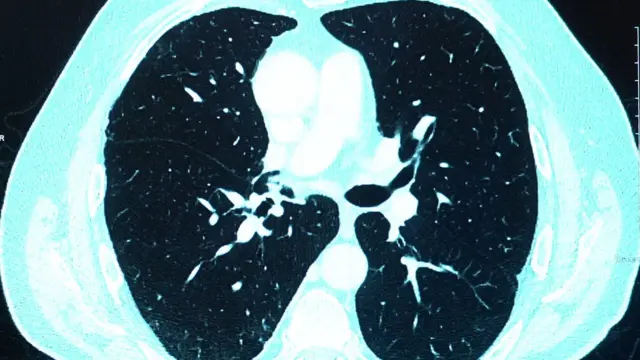 কোভিড আক্রান্ত হবার আগে ফুসফুসের ছবি