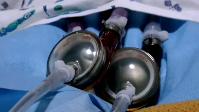 மூன்று வயதுக் குழந்தைக்கு உடலுக்கு வெளியில் செயற்கை இதயம்